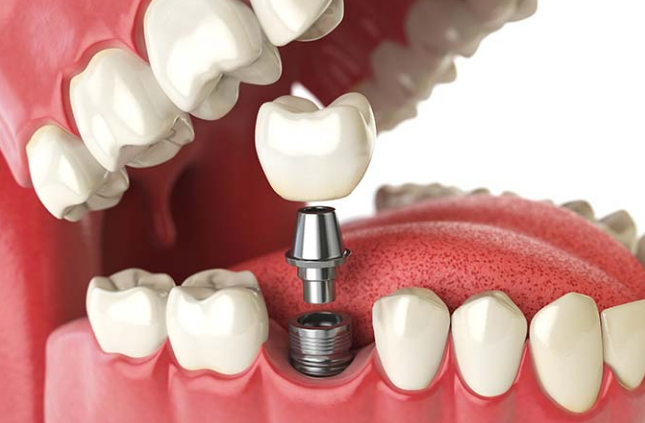 6 Guidelines Associated With Dental Implant Procedure And Surgery